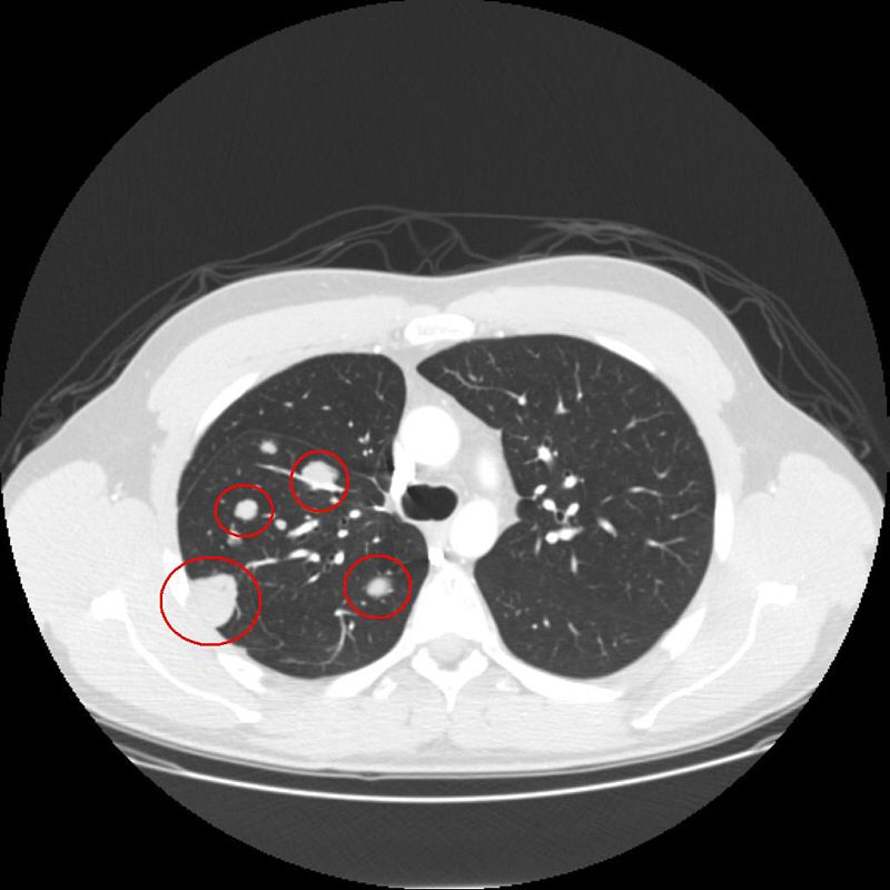 CT là gì? PET/CT là gì? MRI là gì? Phân biệt các phương pháp chẩn đoán hình ảnh trong ung thư - hình minh họa 1