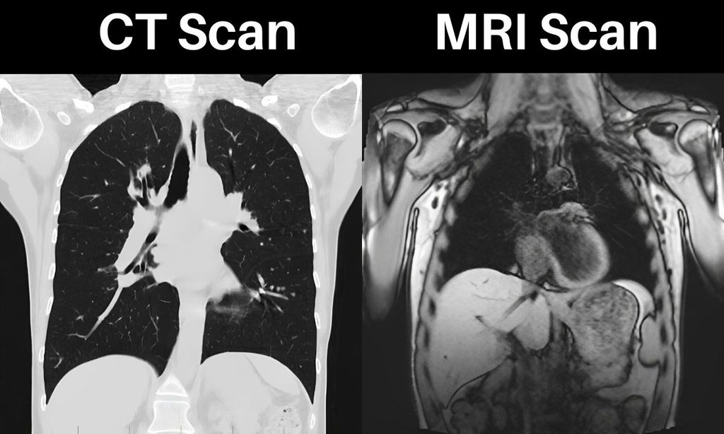 CT là gì? PET/CT là gì? MRI là gì? Phân biệt các phương pháp chẩn đoán hình ảnh trong ung thư - hình minh họa 2