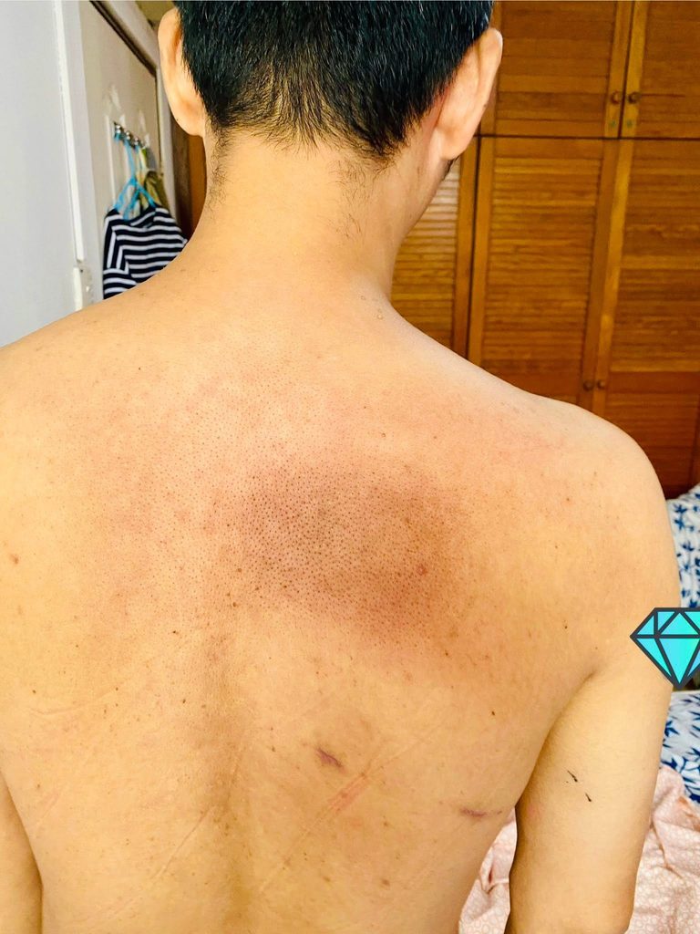 Ung thư phổi là gì? - hình minh họa 2
