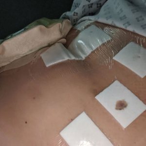 Ung thư đại trực tràng là gì?