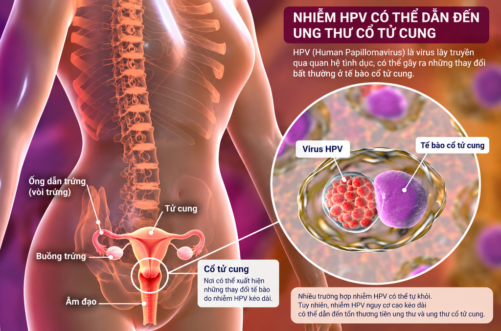 Ung thư cổ tử cung là gì? - hình minh họa 3