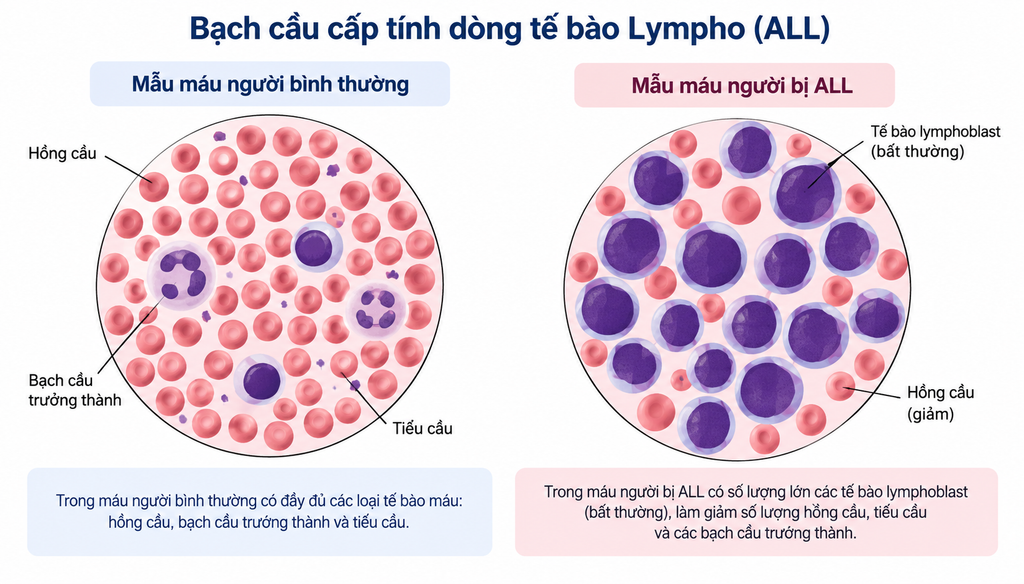 Bệnh bạch cầu cấp tính thể lympho (ALL) ở người lớn - hình minh họa 1
