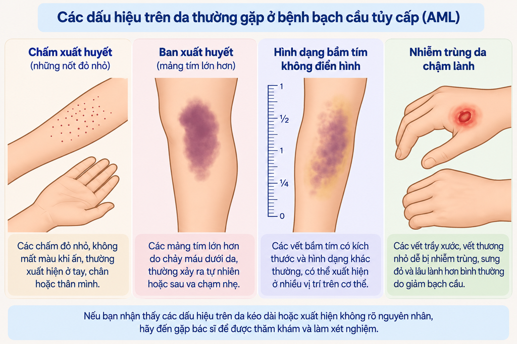 Bệnh bạch cầu cấp dòng tủy (AML): Nguyên nhân, triệu chứng, chẩn đoán và điều trị - hình minh họa 3