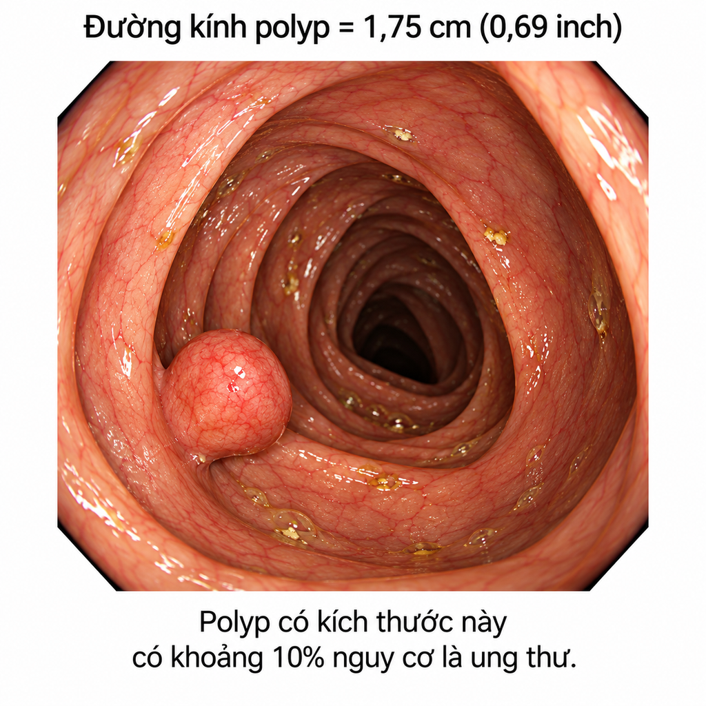 Polyp đại tràng có phải ung thư không? - hình minh họa 1