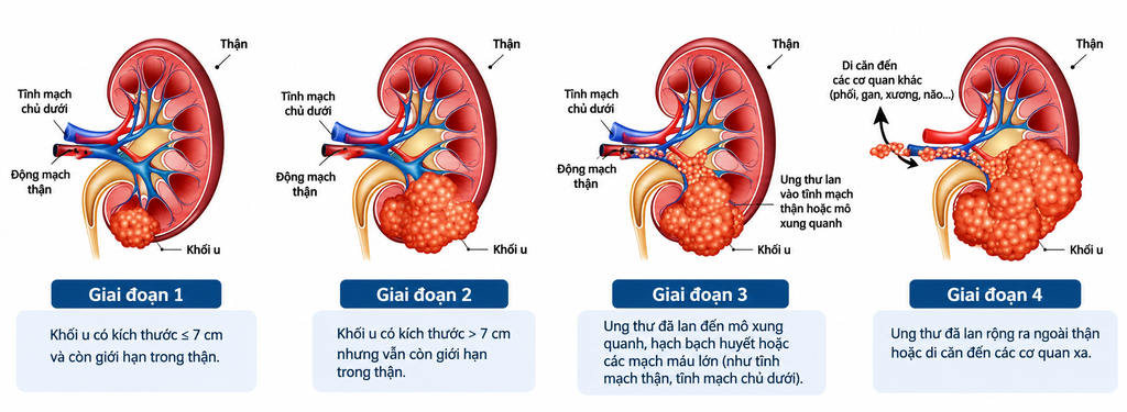 Ung thư thận là gì? - hình minh họa 1
