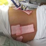 Ghép tủy ở Singapore hết bao nhiêu tiền? Cần chuẩn bị những gì?