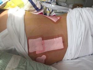 Ghép tủy ở Singapore hết bao nhiêu tiền? Cần chuẩn bị những gì?